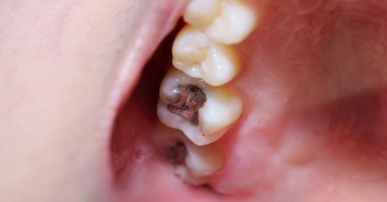 Why Does My Tooth Filling Hurt After Months - Think Different